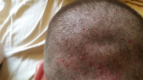 Scalp Acnefolliculitis Pictures General Acne Discussion By