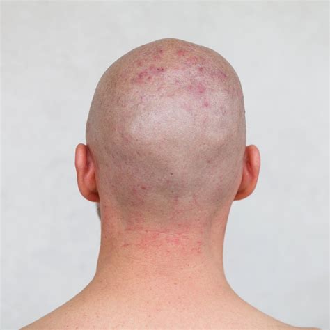 Top More Than 134 Pimples In Hair Scalp Latest Vn