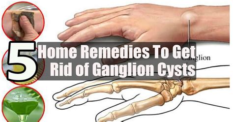 How Do You Get Ganglion Cyst On Your Foot Margaret Greene Kapsels