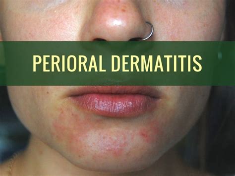 Perioral Dermatitis Causes Symptoms And Treatments