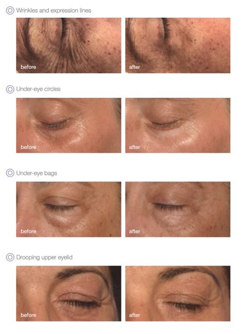 Global Eyecon Treatment Revive Skin And Laser