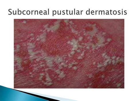 Acute Generalized Exanthematous Pustulosis Agep