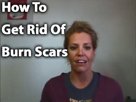 I applied no marks cream and coconut oil but nothing worked. How To Get Rid of Burn Scars - YouTube