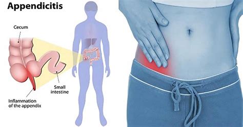 Appendicitis Causes Pain Symptoms Signs And Treatment