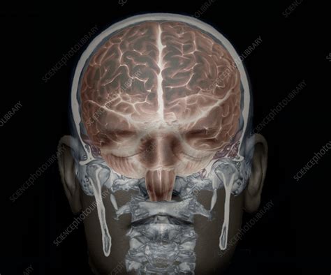 Brain And Skull Anatomy 3d Ct Scan Stock Image C0337386 Science