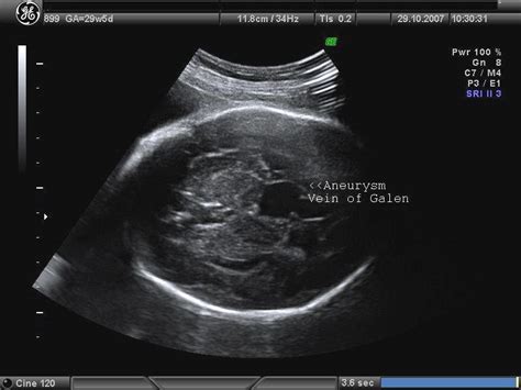 Ultrasound Images Of Fetal Brain