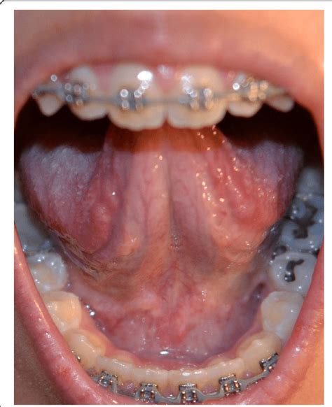 Intra Oral View Demonstrating Absence Of Lingual Frenum And Otherwise
