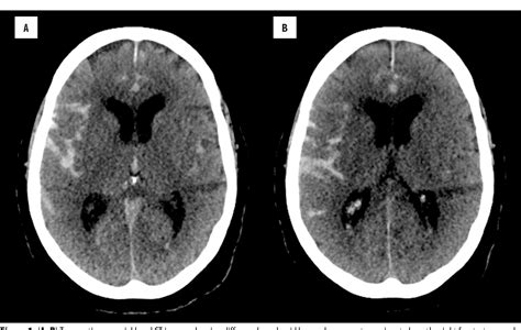 Figure 2 From Diffuse Subarachnoid Hemorrhage Secondary To Cerebral