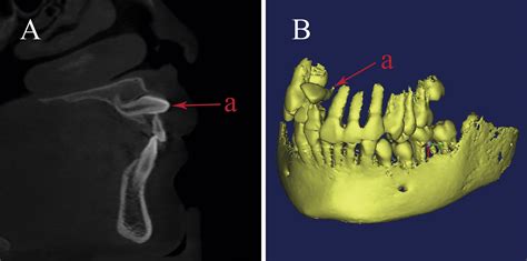 An Analysis Of Clinical And Imaging Features Of Unilateral Impacted