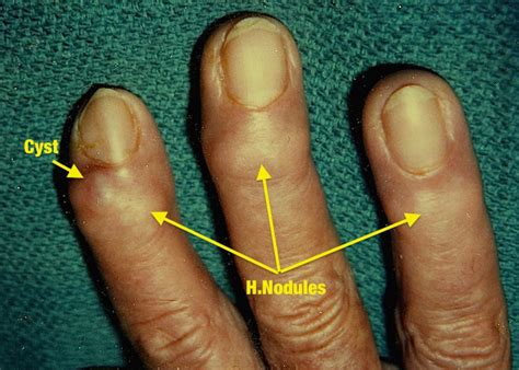 Mucous Cyst Hand Surgery Resource
