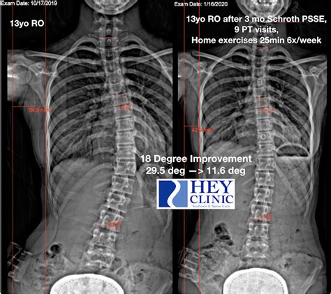 Schroth Therapy Reverses Scoliosis Curve Hey Clinic