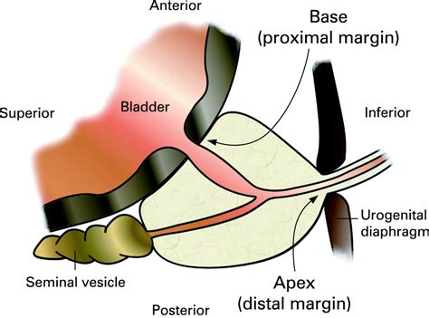 Guidelines For The Macroscopic Processing Of Radical Prostatectomy And