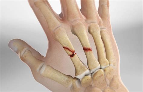 Fractures Teton Hand Surgery
