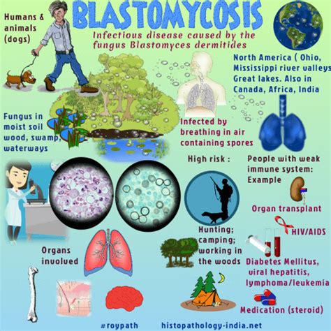 Pathology Of Blastomycosis Dr Sampurna Roy Md