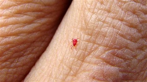 How To Know When Its A Chigger Bite Everyday Health