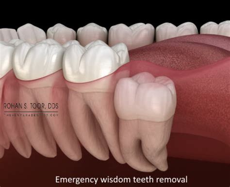 Emergency Wisdom Teeth Removal Ventura Ca California Same Day