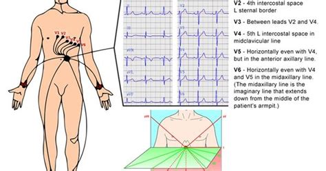 12 Lead Ecg Electrode Placement The Art Of Reality January 2012