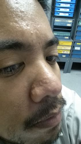 Bumps On Nose Not Pimples General Acne Discussion