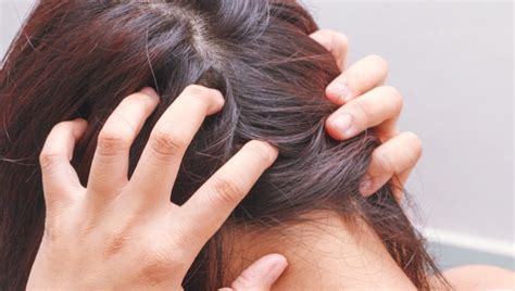 Home Remedies For Scalp Fungus Infection