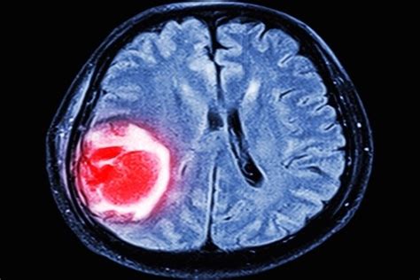 Trombosis Cerebral Qué Es Síntomas Secuelas Y Tratamiento Tua Saúde