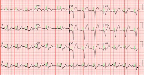 Dr Smiths Ecg Blog A Patient With A Ventricular Paced Rhythm And