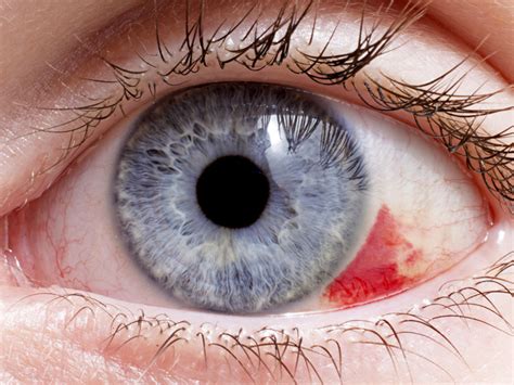 Punto De Sangre En El Ojo Causas Del Derrame Ocular