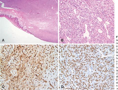 Figure 3 From A Case Of Solitary Fibrous Tumor Of Hard Palate