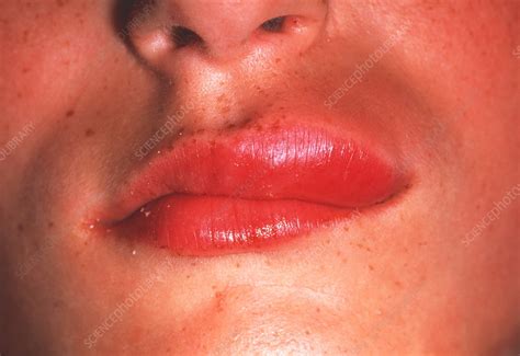 Swollen Lip Stock Image M3300889 Science Photo Library