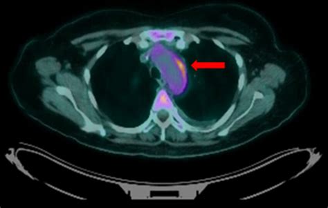 Fused Axial 18 F Fdg Pet Ct Shows Increased Fdg Avidity In The Aortic