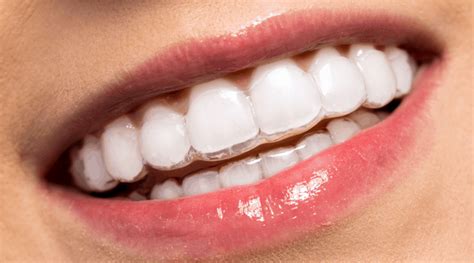 Invisalign® Liverpool Invisible And Clear Braces Cost £7351pm