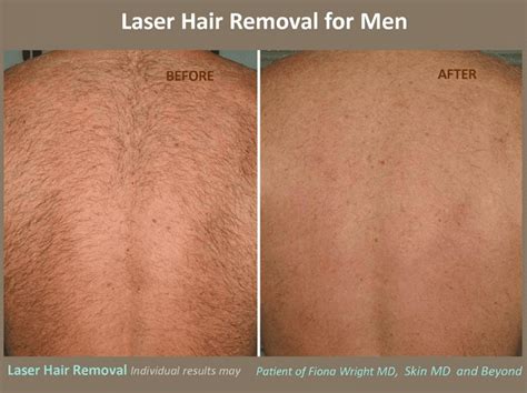 The hairmax laser is beneficial to grow hair. Male Laser Hair Removal Plano TX | Skin MD & Beyond