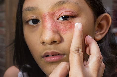 How To Manage Eczema Around The Eyes Healthwire