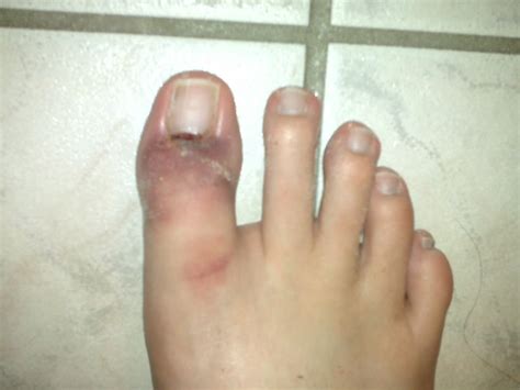 Turf toe happens when you bend your big toe up toward the top of your foot too far. Turf Toe Images