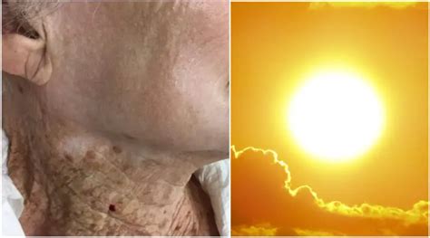 This Woman Wore Sunscreen On Her Face But Not Neck For Years And This Is The Result