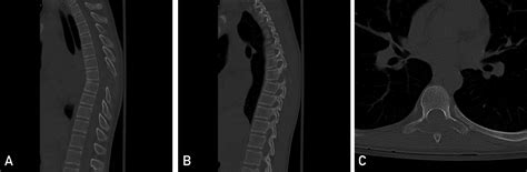 Spinal Aneurysmal Bone Cyst Causing Spinal Cord Compression Mayo