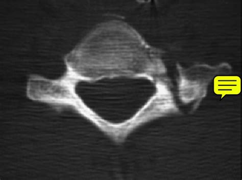 28 Articular Pillar Fracture Associated With Hyperextension Injury
