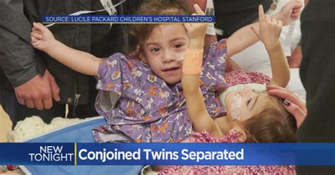 Conjoined Sacramento Twins Survive Marathon Separation Surgery Cbs