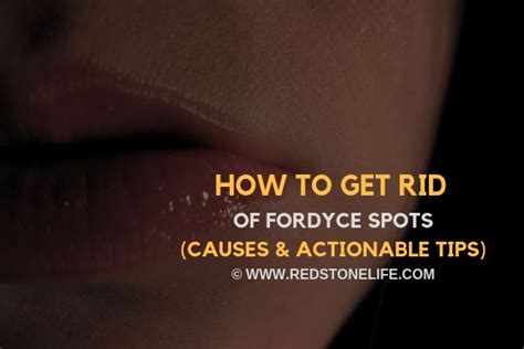 How To Get Rid Of Fordyce Spots Causes Actionable Tips Fordyce