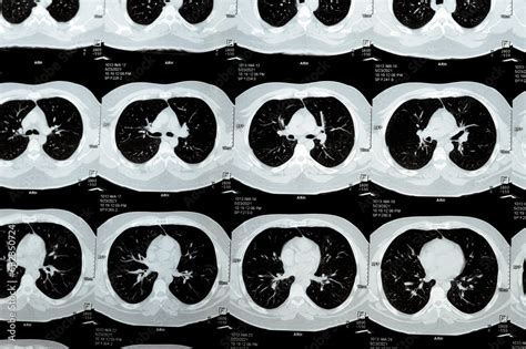 Multi Slice Ct Scan Of The Chest Showing Normal Study Normal