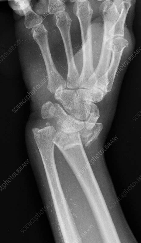 Wrist Fracture X Ray Stock Image C0393360 Science Photo Library