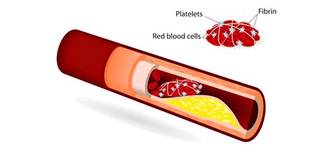 Blood Clot Symptoms And Causes • Heart Research Institute