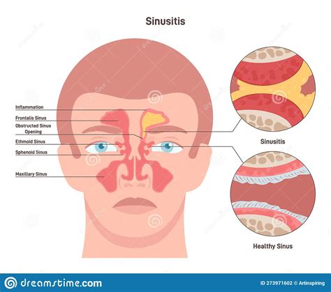 Sinusitis Inflamed Sinus With Excess Mucus And Obstructed Airways