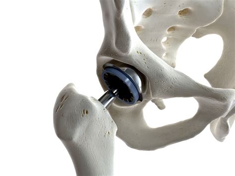 How Metal Hip Implants Can Cause Metallosis Morris Law Firm
