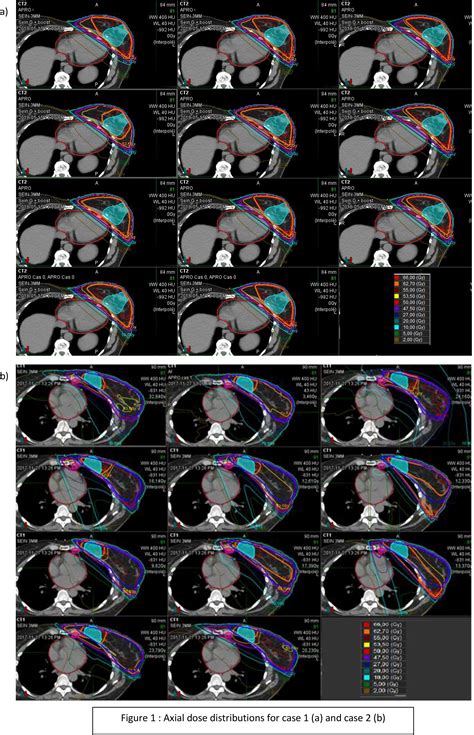 22 A Multi Center Study Of Breast Irradiation Techniques Physica