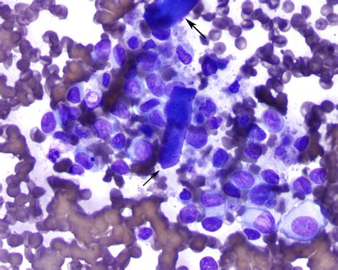 Discrete Cell Tumors EClinpath