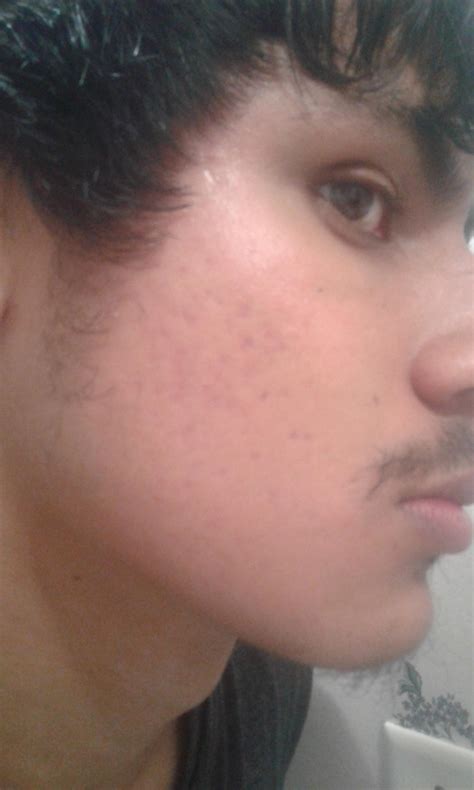 Pitted Acne Scars Scar Treatments Forum