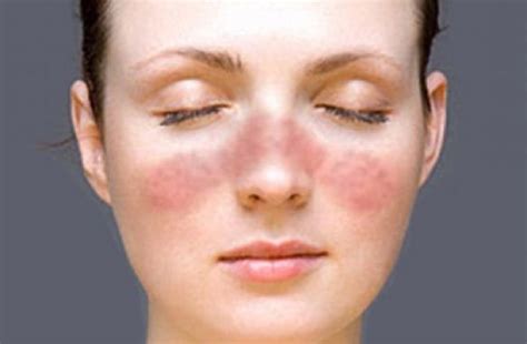 The Symptoms That Mean You May Have Lupus Lifedaily