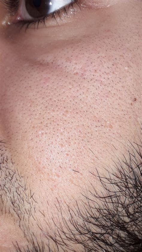 Large Pores And Hair On Upper Cheeks Any Clues On What To Do R