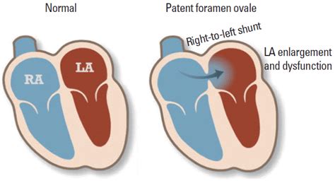 Patent Foramen Ovale And Strokecurrent Status