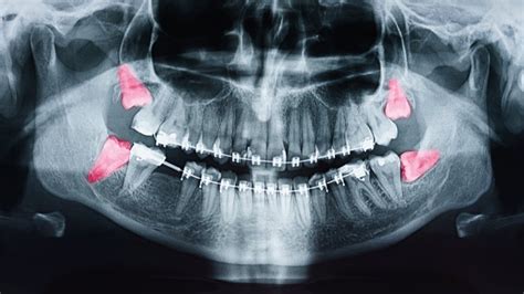 Signs Of Impacted Wisdom Teeth Prosper Dentist Texas Dental Surgery